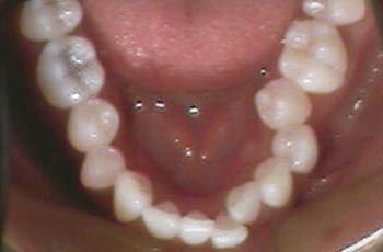 Invisalign Before Lower