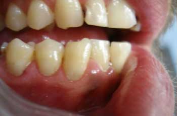 Bonded Fillings After