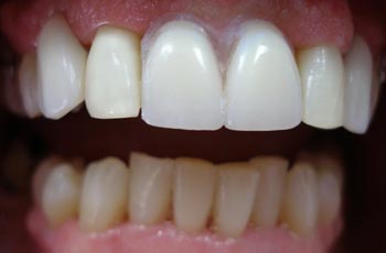 Removable Partial Denture After