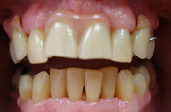 Removable Partial Denture Before